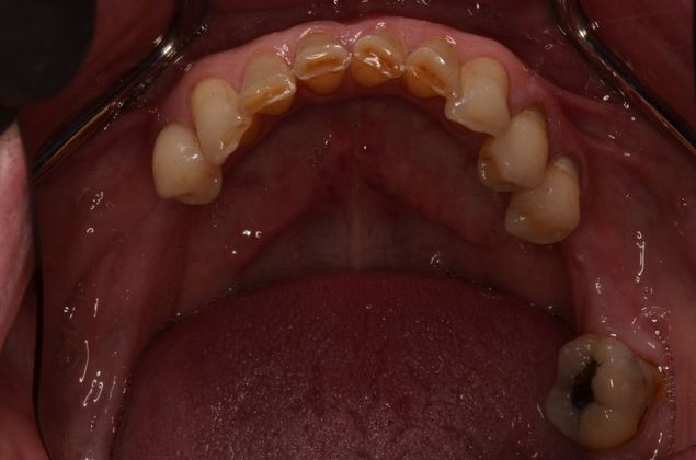 Dental Implants Case 37 - Before