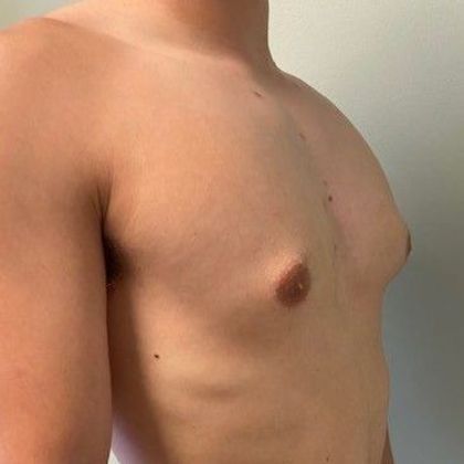Male Breast Reduction: Case 5 Gynecomastia, Minimally invasive, Norwalk, CT - Before