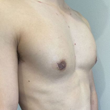 Male Breast Reduction: Case 5 Gynecomastia, Minimally invasive, Norwalk, CT - After