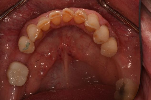 Dental Implants Case 37 - After