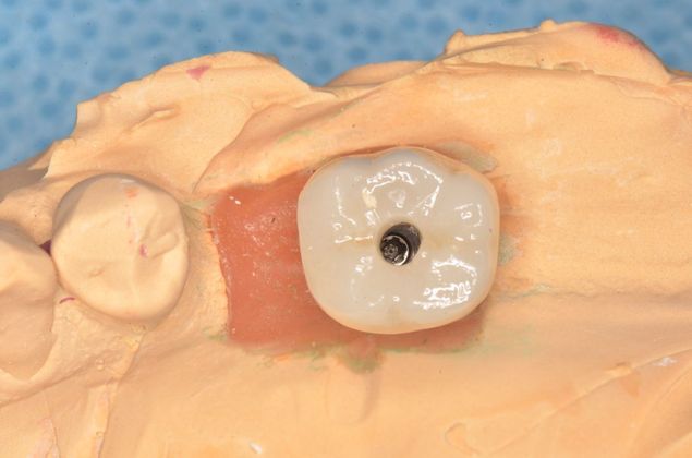 Dental Implants: Case 37 - porcelain screw retained crown for implant on the lab model