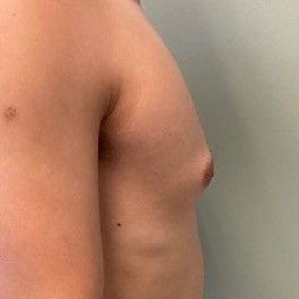 Male Breast Reduction: Case 5 Gynecomastia, Minimally invasive, Norwalk, CT - Before