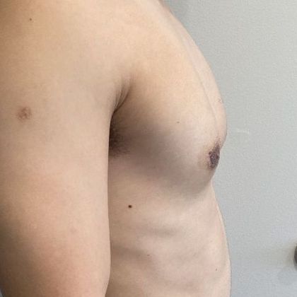Male Breast Reduction: Case 5 Gynecomastia, Minimally invasive, Norwalk, CT - After