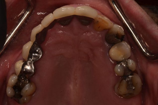 Dental Implants: Case 38 - Before fractured bridge removal