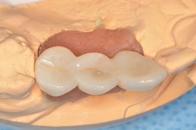 Dental Implants: Case 38 - Implant supported bridge on lab model
