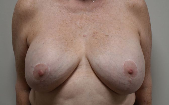 Breast Revision: Case 154 - Before