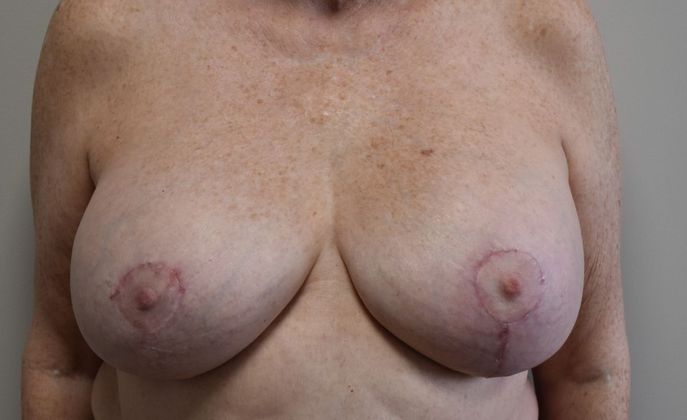 Breast Revision: Case 154 - After