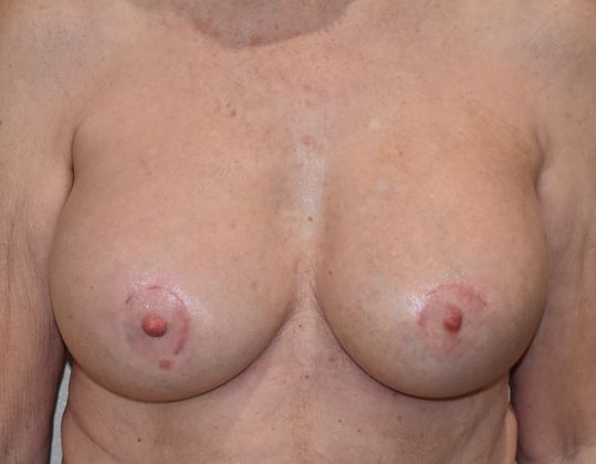 Breast Revision: Case 155 - After