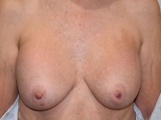 Breast Revision: Case 155 - Before