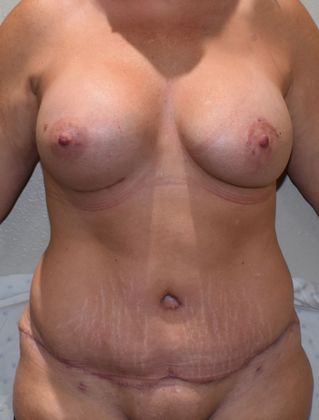 Mommy Makeover Case 166 - After