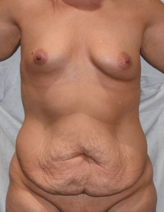 Mommy Makeover Case 166 - Before