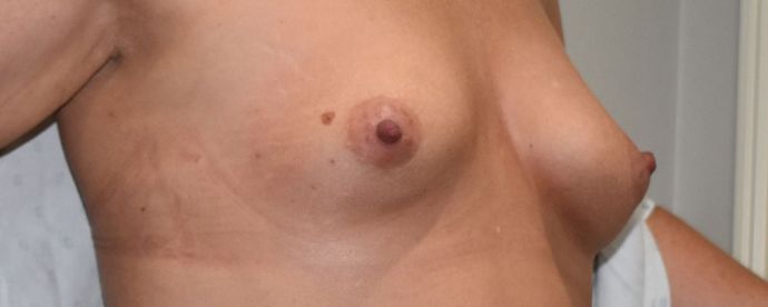 Breast Augmentation: Case 611 - Before