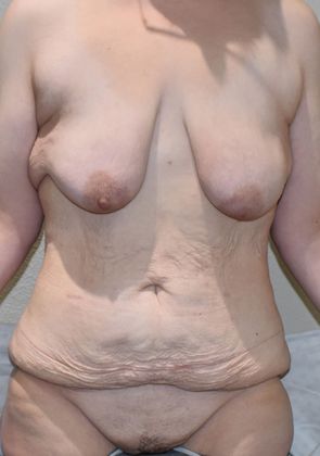 Mommy Makeover Case 168 - Before