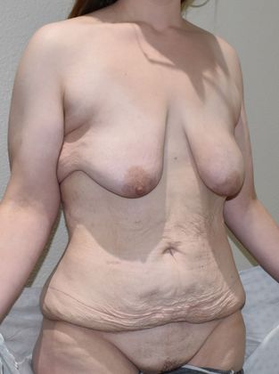 Mommy Makeover: Case 168 - Before