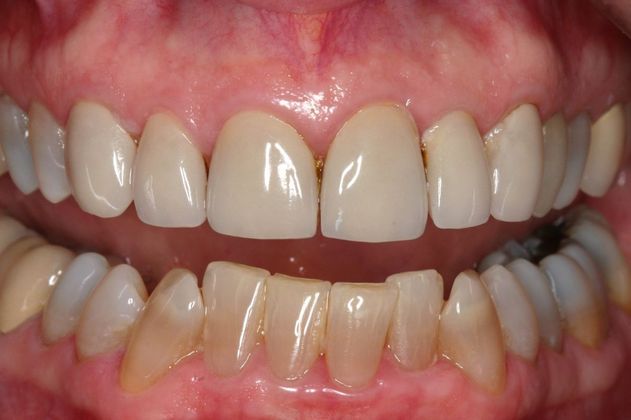 Veneers Anne - Before