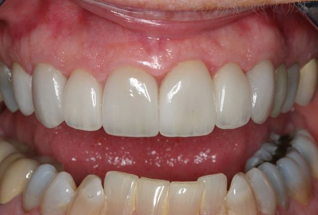 Veneers Anne - After