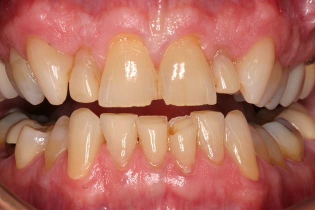 Veneers Bernie - Before