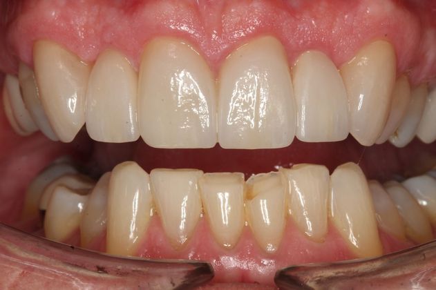 Veneers Bernie - After