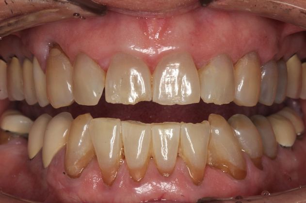 Veneers Jay - Before