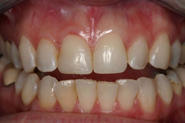 Veneers Julie - Before