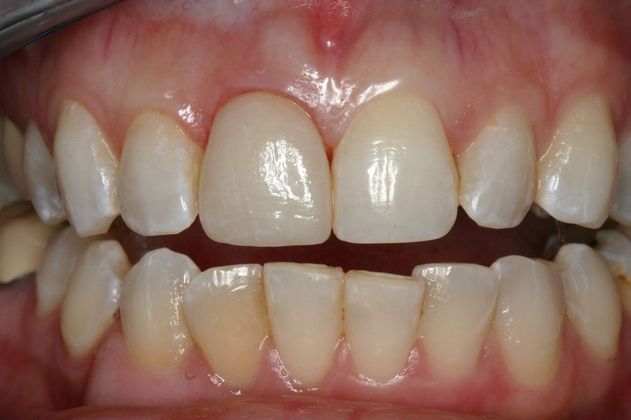 Veneers Julie - After