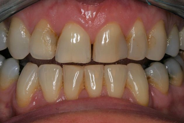 Veneers Laura - Before