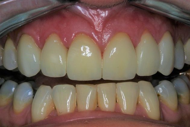 Veneers Laura - After