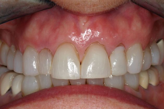 Veneers Linda - Before