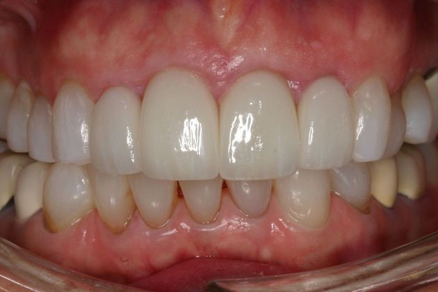 Veneers Linda - After