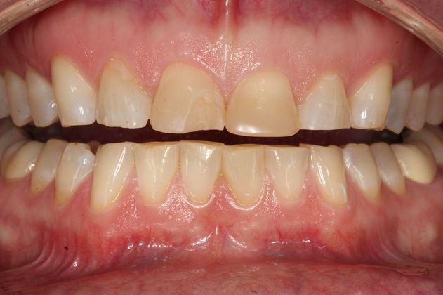 Veneers Ruth F. - Before