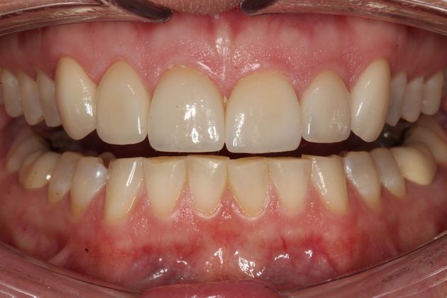 Veneers Ruth F. - After