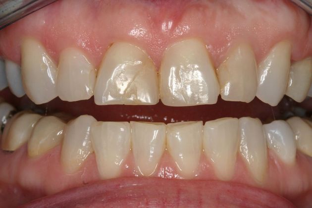 Veneers Tracey - Before