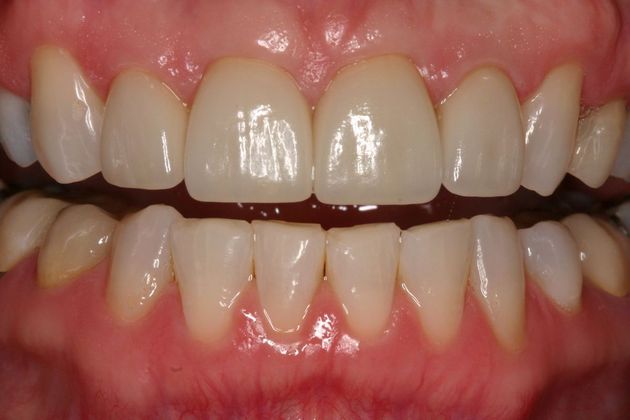 Veneers Tracey - After