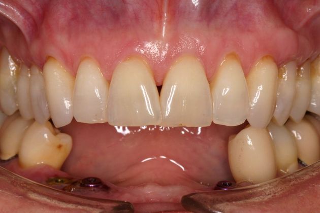 Implant Restorations Betty - Before