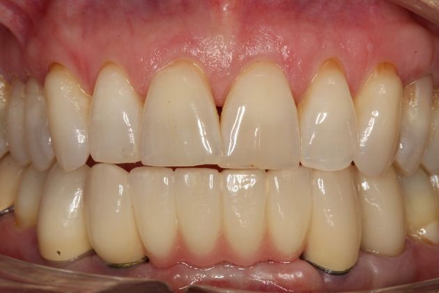 Implant Restorations Betty - After