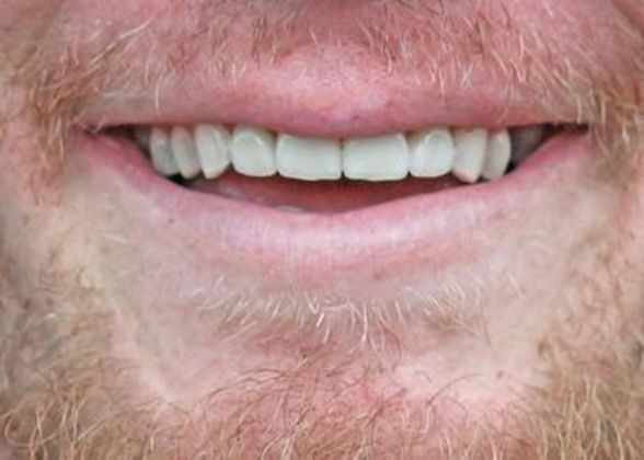 Veneers and Crowns: Case 2 - Before