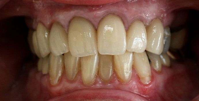 Veneers and Crowns: Case 3 - After