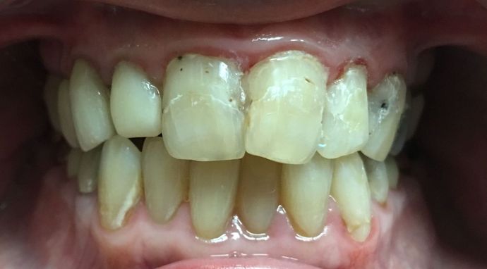 Veneers and Crowns: Case 3 - Before