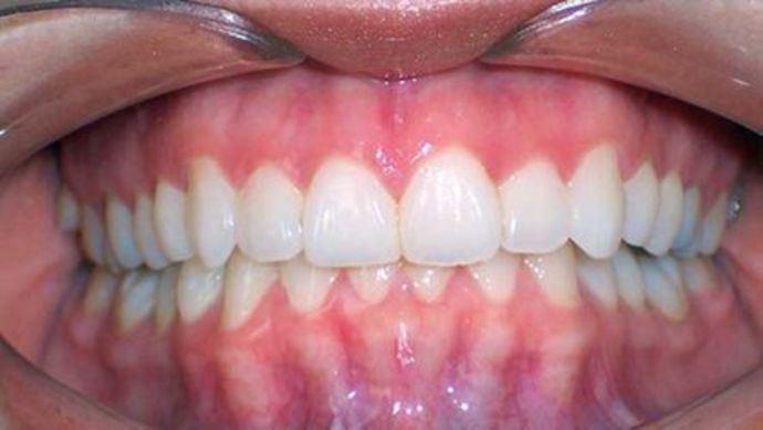 Orthodontics Case 1 - After