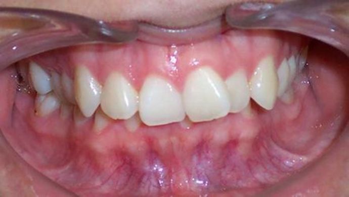 Orthodontics Case 1 - Before