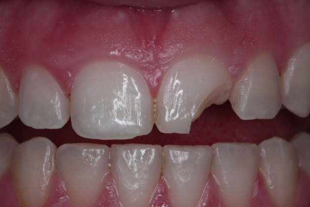 Cosmetic Bonding Elyse - Before