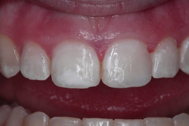 Cosmetic Bonding Elyse - After