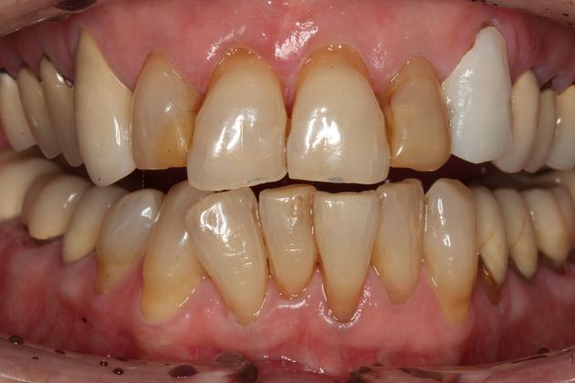 Crowns Jane - Before