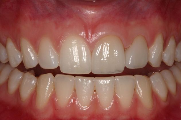 Crowns Madison - Before