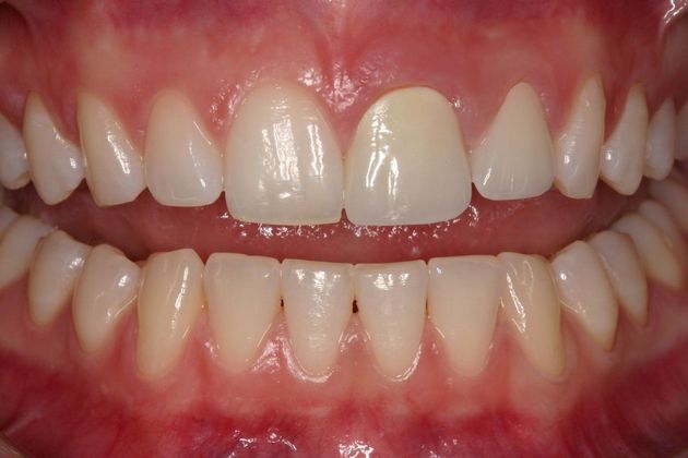 Crowns Madison - After