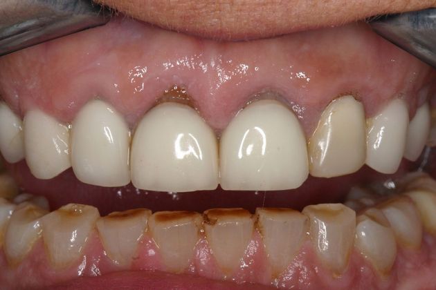 Crowns Pamela - Before