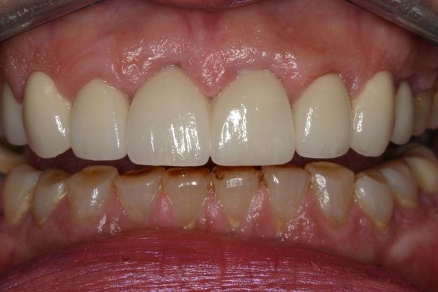 Crowns Pamela - After