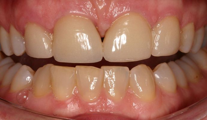 Crowns Sylvie - Before