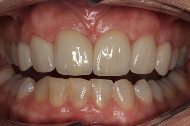 Crowns Sylvie - After