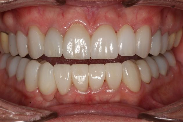 Full Mouth Rehabilitation Kathy - After